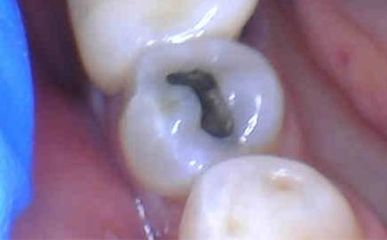 Tooth with large metal amalgam filling