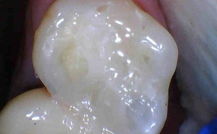 Tooth with natural looking tooth colored fillings