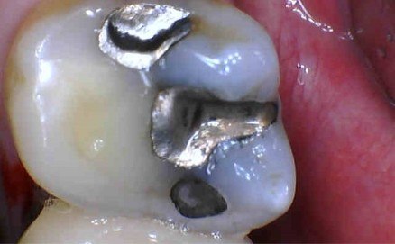 Tooth with several large  metal amalgam filling