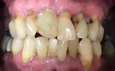 Severely decayed and damaged teeth