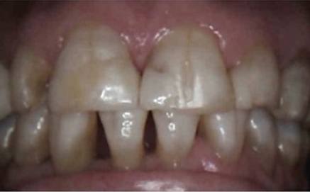 Severely decayed and discolored treeth before smile makeover