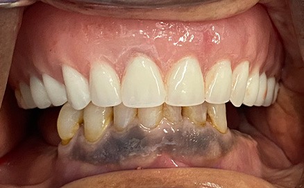 Three teeth in a row repaired with tooth colored dental restorations