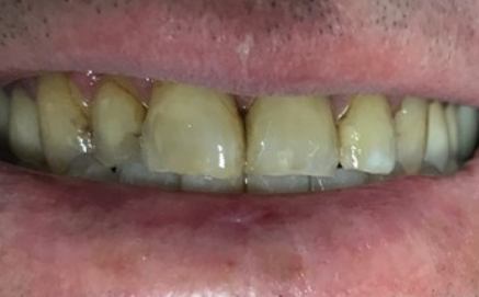 Row of yellowed top teeth before cosmetic dentistry