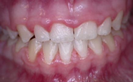 Gummy smile before cosmetic gum recontouring treatment