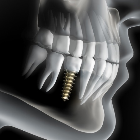 Animated smile with dental implant supported dental crown restoration