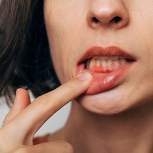 Lady shows gum tissue