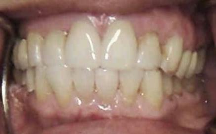 Healthy smile after cosmetic dentistry