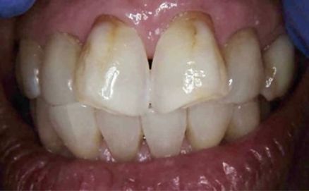 Discolored teeth before cosmetic dentistry