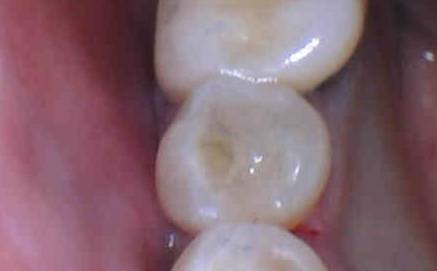 Tooth with natural looking tooth colored fillings