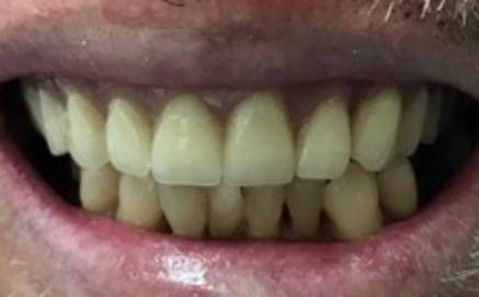 Damaged teeth replaced with immediate dentures