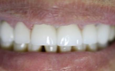 Healthy beautiful smile after smile makeover