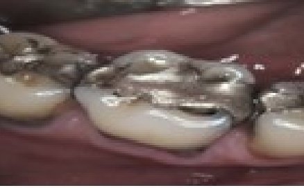 Three teeth in a row with metal amalgam fillings