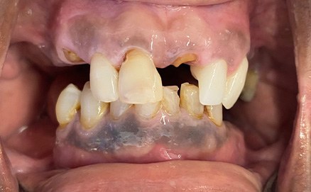 Three teeth in a row with metal amalgam fillings