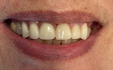 Three teeth in a row repaired with tooth colored dental restorations