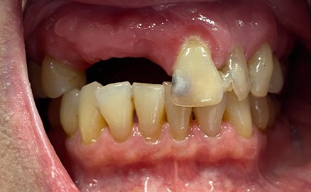 Three teeth in a row with metal amalgam fillings