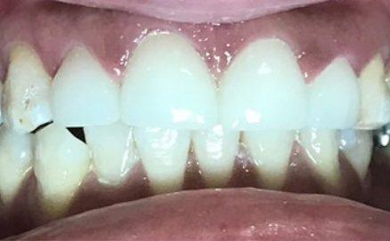 Healthy beautiful smile after complete dental restoration