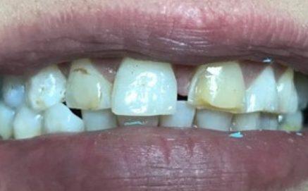 Damaged and decayed teeth before complete dental restoration