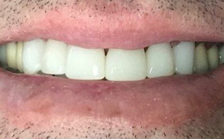 Bright white smile after cosmetic dentistry