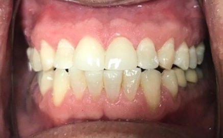 Metal caps replaced with tooth colored dental crowns