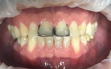 Metal caps on top front two teeth