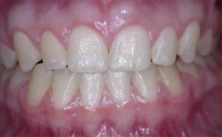 Flawless smile after cosmetic gum recontouring treatment