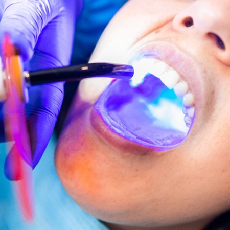 a child having their tooth bonded