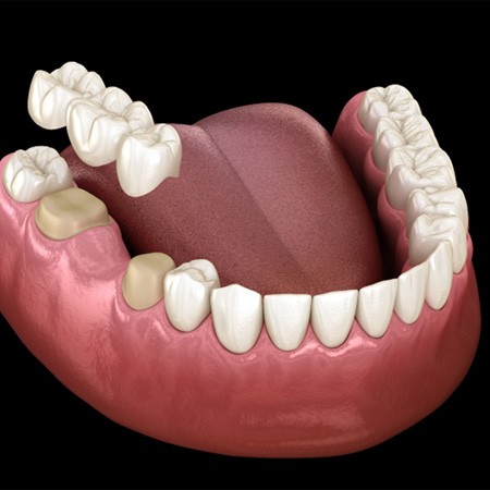 Illustration of dental bridge in Fresno, CA for lower arch