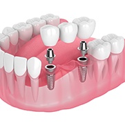 Digital illustration of an implant bridge in Fresno 