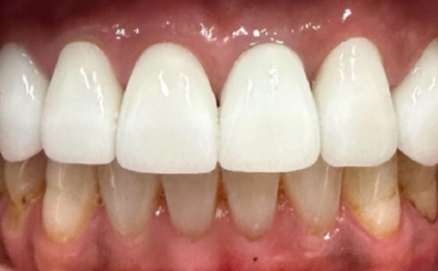 Close up of a mouth after treating stains on the teeth