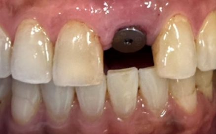 Close up of a mouth with slightly stained teeth