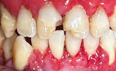 Close up of a mouth after treating stains on the teeth