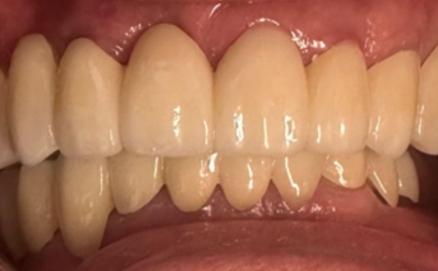 Close up of a mouth after treating stains on the teeth