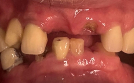 Close up of a mouth with slightly stained teeth