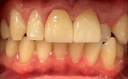 Close up of a mouth after treating stains on the teeth