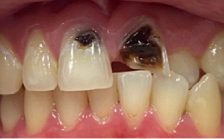 Close up of a mouth with slightly stained teeth