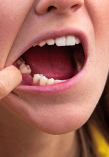 Closeup of a missing tooth