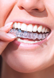 Woman putting in Invisalign