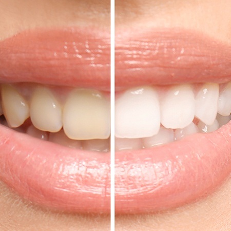 Smile before and after teeth whitening