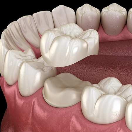 example of process for dental crowns in Fresno