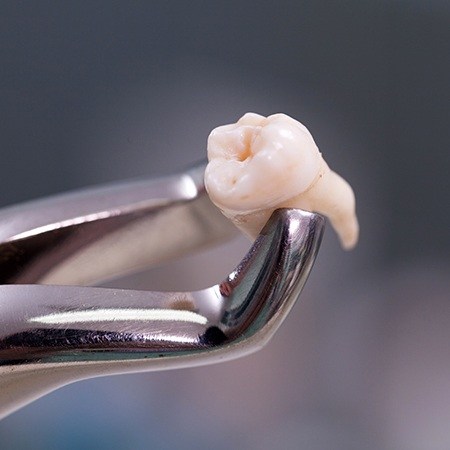 Metal clasp holding an extracted wisdom tooth