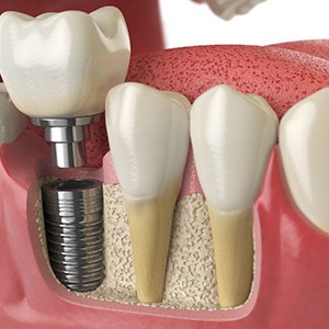 An illustration of implant parts, which affect the cost of dental implants in Fresno