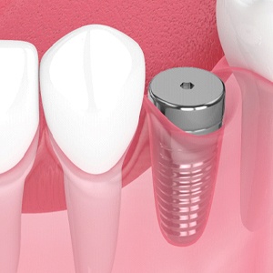 Digital illustration of dental implant in Fresno
