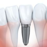 Animateddental implant supported dental crown placement
