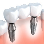 Animated dental implant supported fixed bridge placement