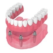 Animated dental implant supported denture