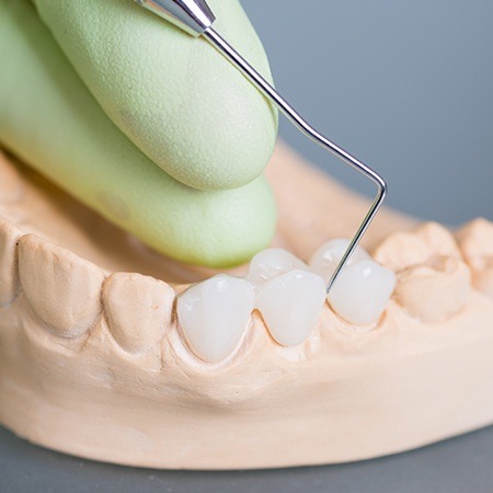 Model smile with dental bridge tooth replacement