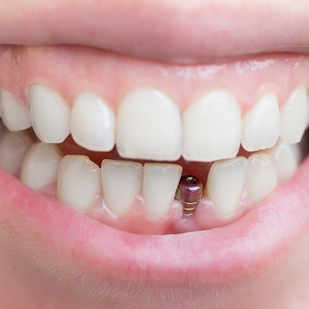 Patient's smile with dental implant post visible