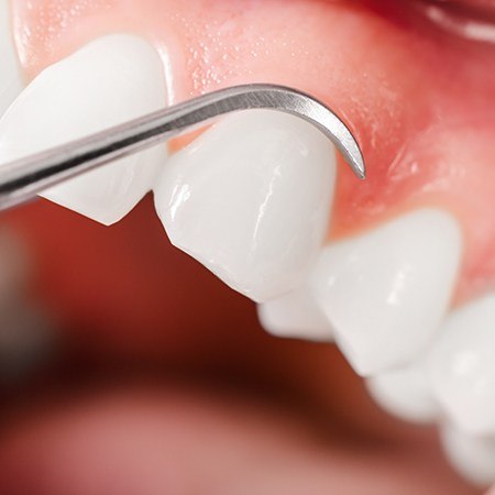 Patient receiving Chao Pinhole Surgical Technique treatment