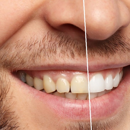 Closeup of patient's smile before and after teeth whitening treatment