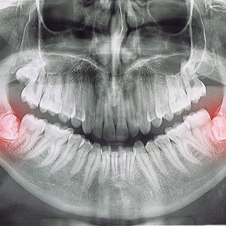 X-ray of wisdom teeth